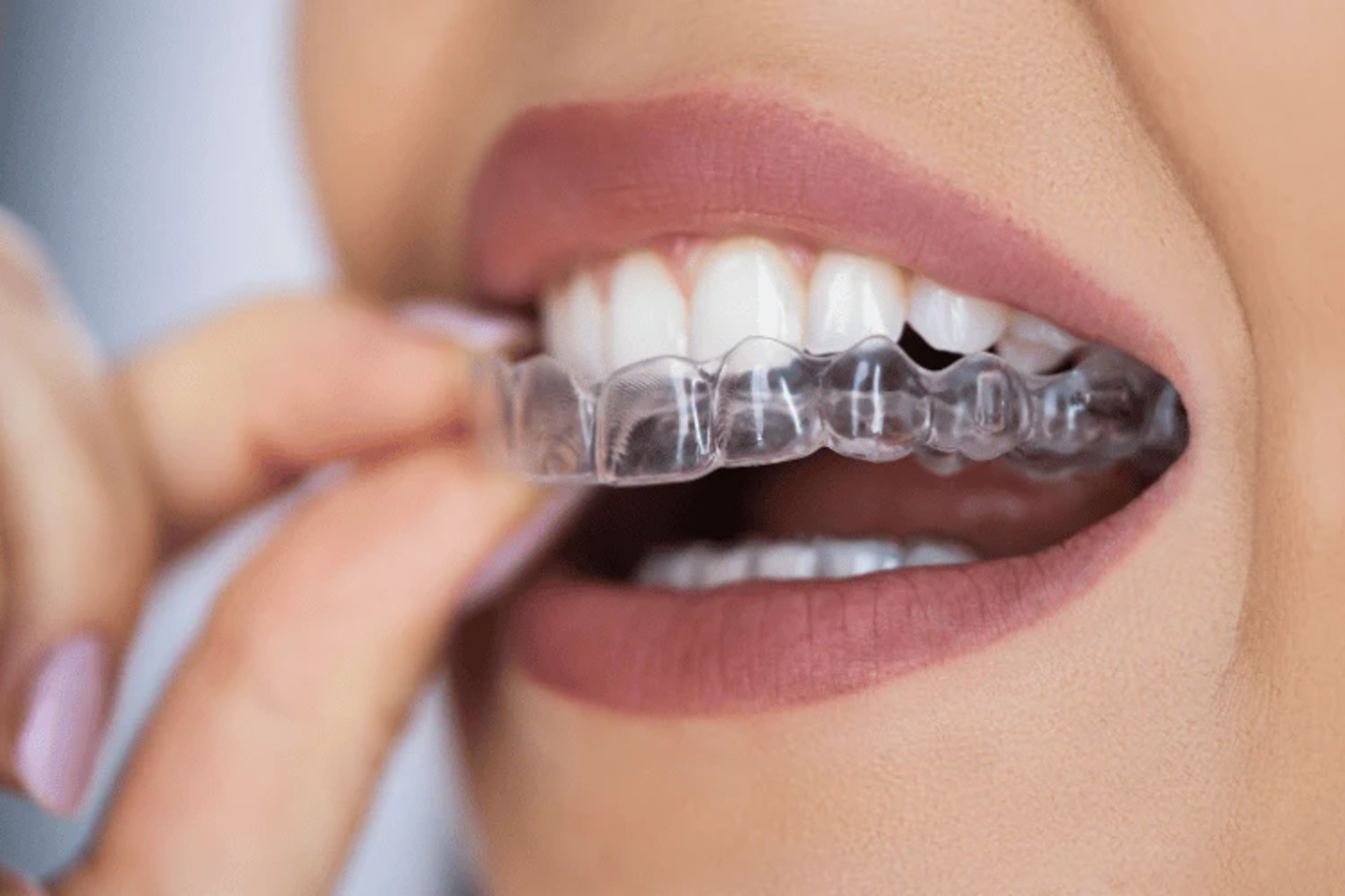 Aligners and the OVO Intraoral scanner 